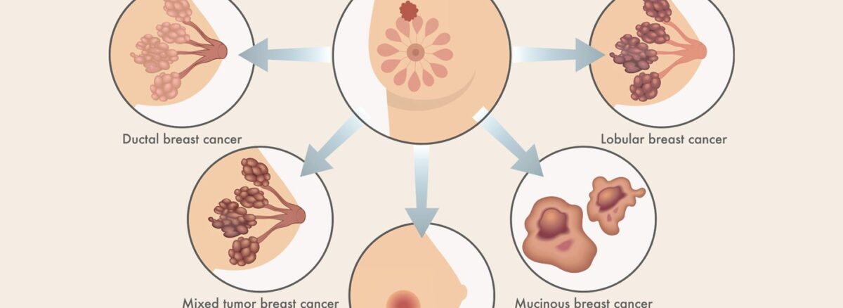 types of breast cancer doctor oncologist