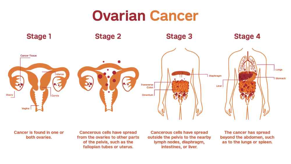 ovarian cancer specialist ghaziabad